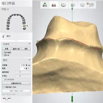 3shape如何画好修复体边缘线